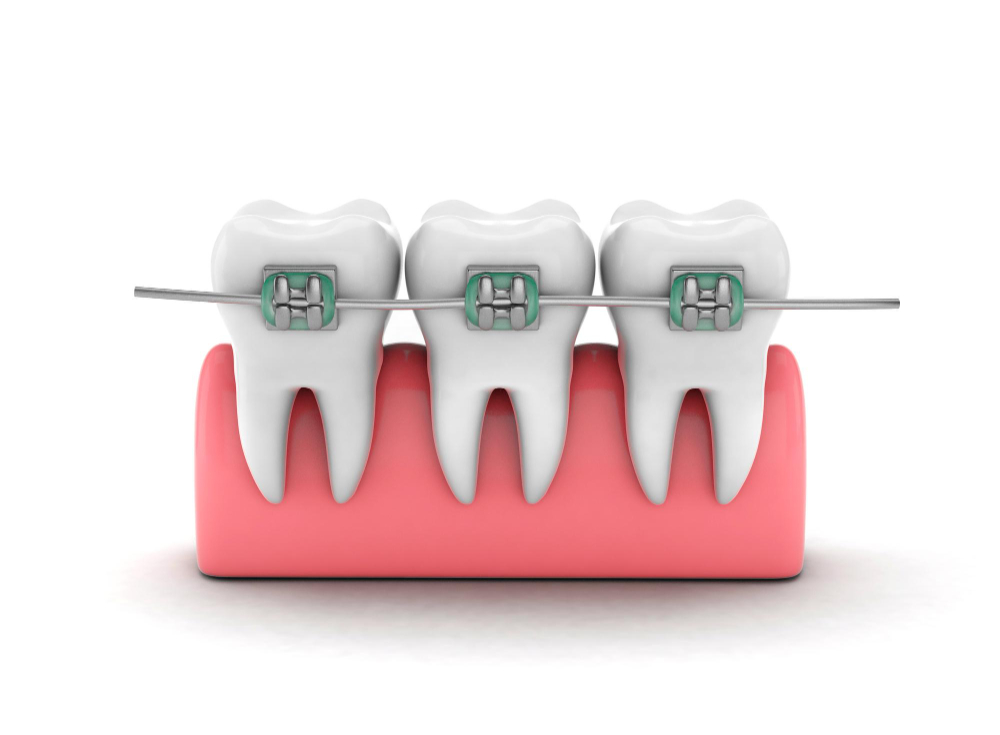teeth-braces-teeth-alignment-teeth-gum-isolated-white-background-3d-render.jpg
