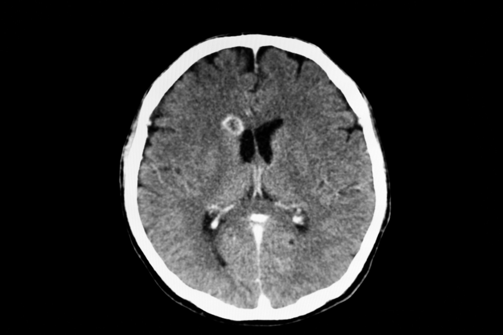 ct-scan-patient-with-brain-abscess.jpg