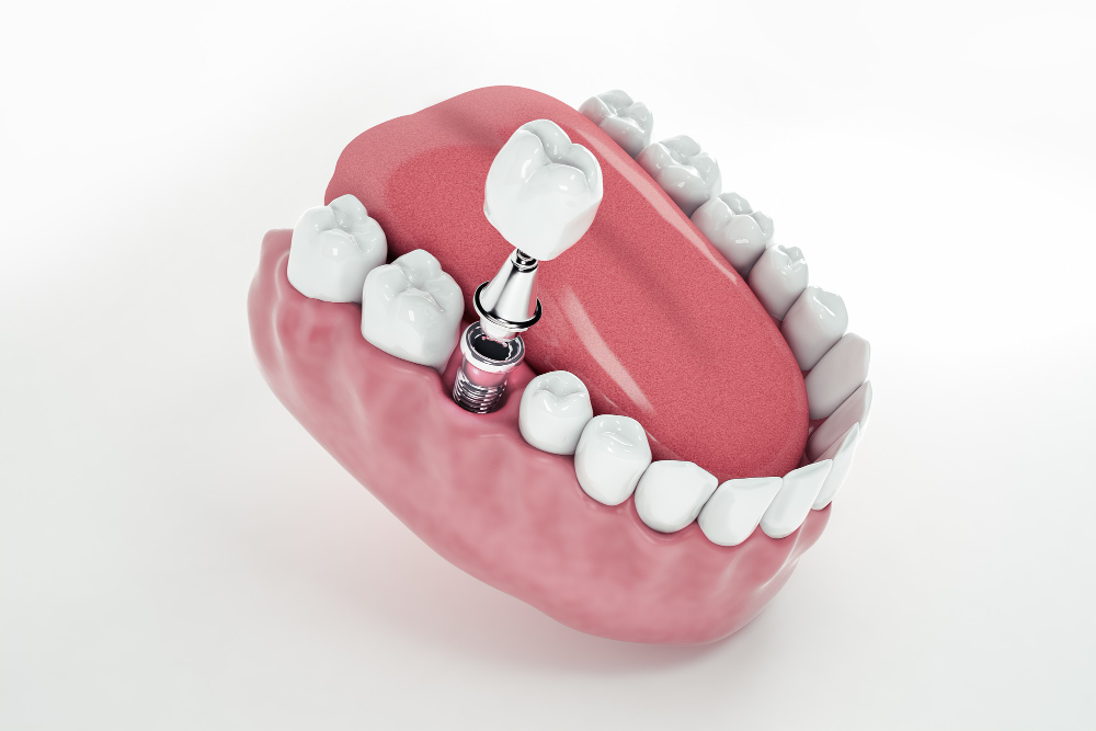 view-from-false-tooth-implant-fixed-jawbone-3d-3d-illustration.jpg