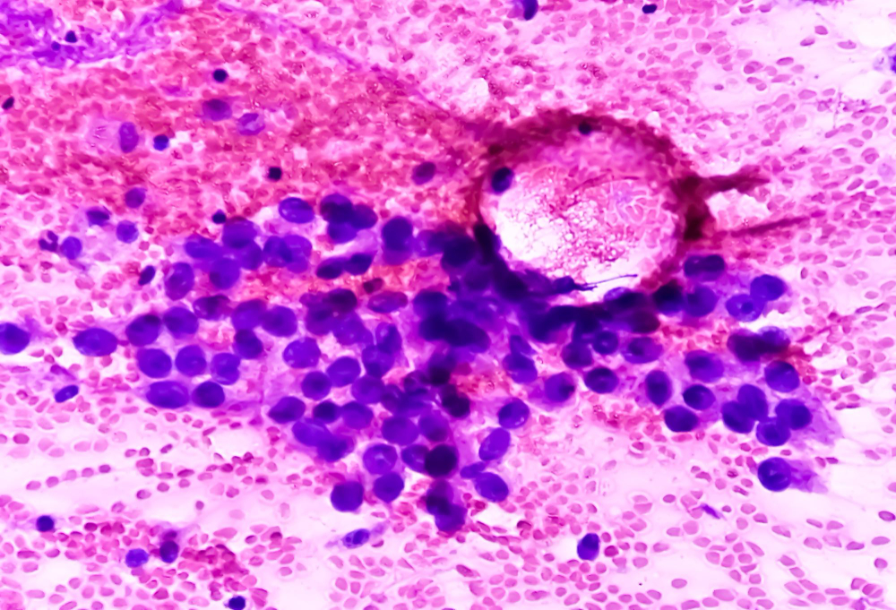 adenocarcinoma-lung-type-non-small-cell-carcinoma-fnac.jpg